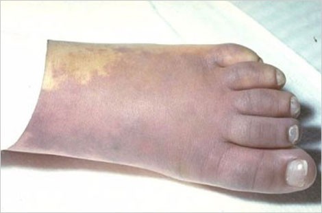 rash on a darker-skinned child's leg, demonstrating that it can be harder to see on darker skin tones