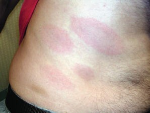 Four pink oval-shaped lesions on the patient's body.