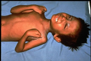 Photos  of clinical manifestations of tetanus