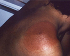A raised, circular, reddish-brown rash on a patient's shoulder.
