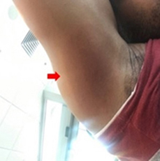 A long, oval, reddish-brown rash on a patient's underarm.