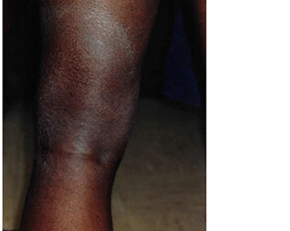 A dark brown rash on the back of a patient's leg.