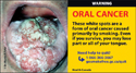 Cancerous tongue.