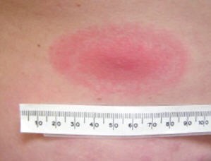 Une éruption cutanée rouge de forme ovale. Un mètre ruban est placé en dessous et montre que l'éruption fait plus de 7 cm de large.