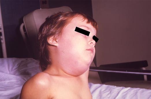 Photo d'un enfant atteint d'une parotidite unilatérale.