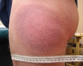 Une grande lésion cutanée circulaire sur la partie supérieure de la jambe d'un patient. La lésion est de couleur bleu-violet. Un mètre ruban montre qu'elle mesure plus de 16 cm de large.