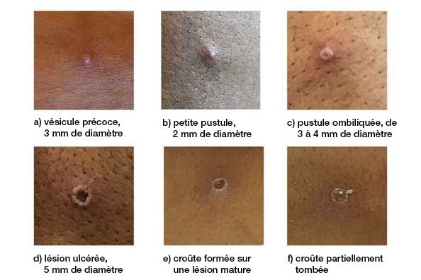 Figure 2. Série de six photos qui montrent les différentes étapes d'une lésion cutanée de la mpox