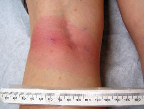 Une éruption cutanée rouge qui s'est étendue sur la largeur de l'arrière d'un genou. Un mètre ruban est placé en dessous et montre que l'éruption mesure 8 cm de large.