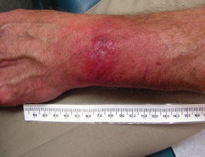 Une éruption cutanée rouge et des cloques sur l'avant-bras d'un patient, avec un mètre ruban montrant que l'éruption cutanée mesure 13 cm de large et que la cloque mesure plus de 2 cm de large.